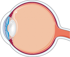cataracta secundara