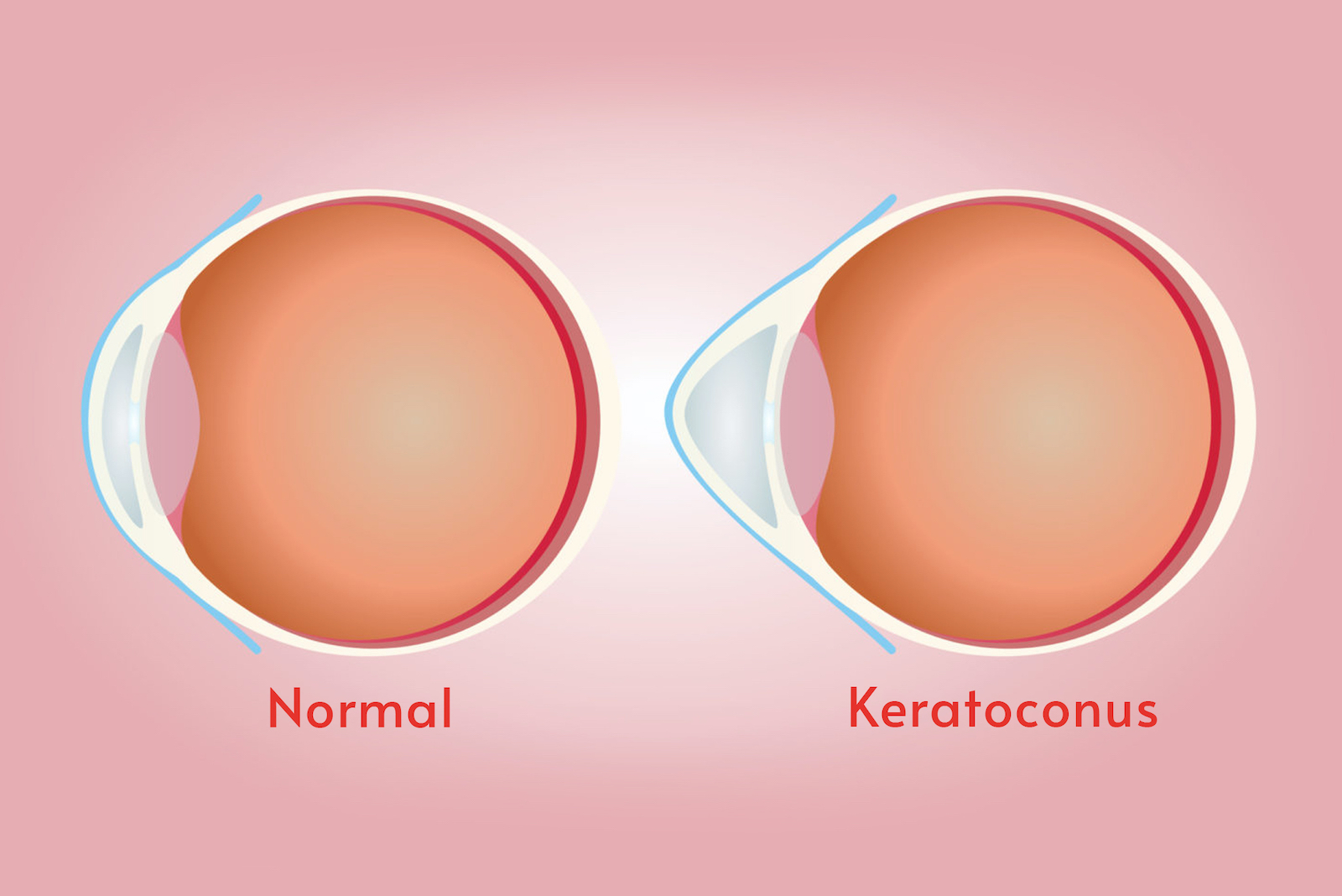 keratoconus ochi