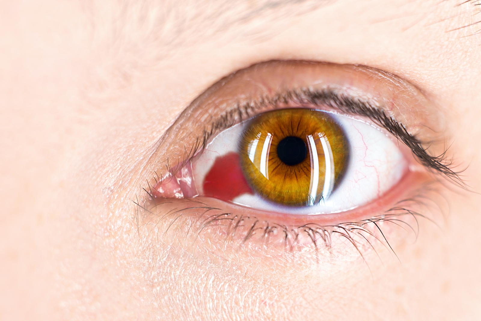 Pată roșie pe ochi? Ce este hemoragia subconjunctivală