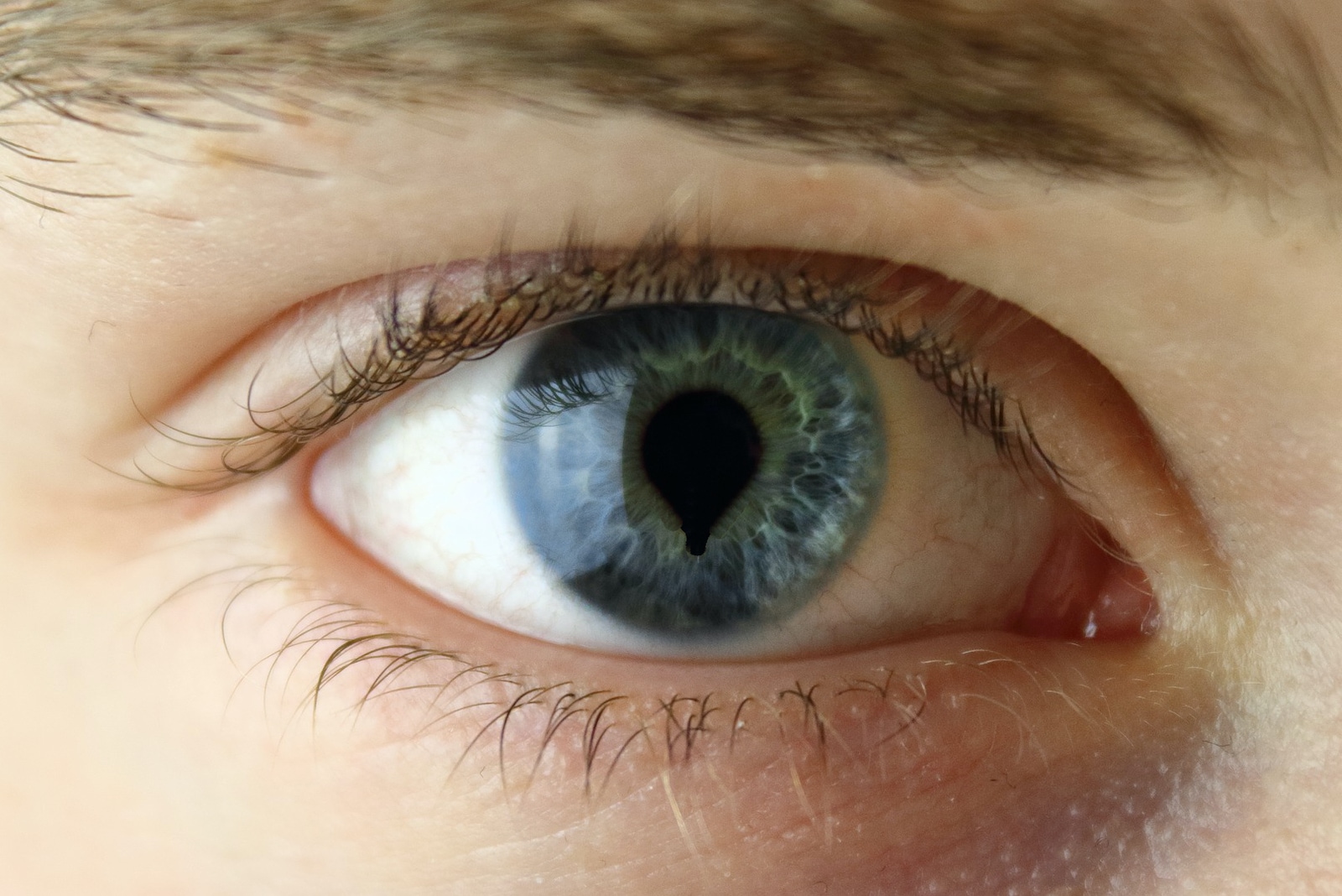 coloboma irisului ochi