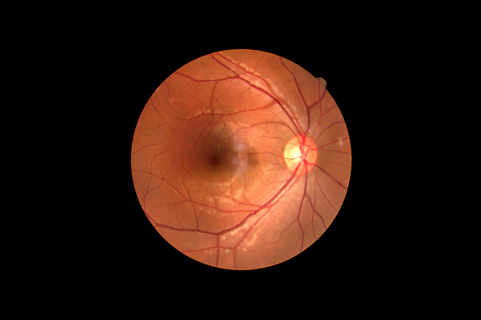 angiopatie retiniana