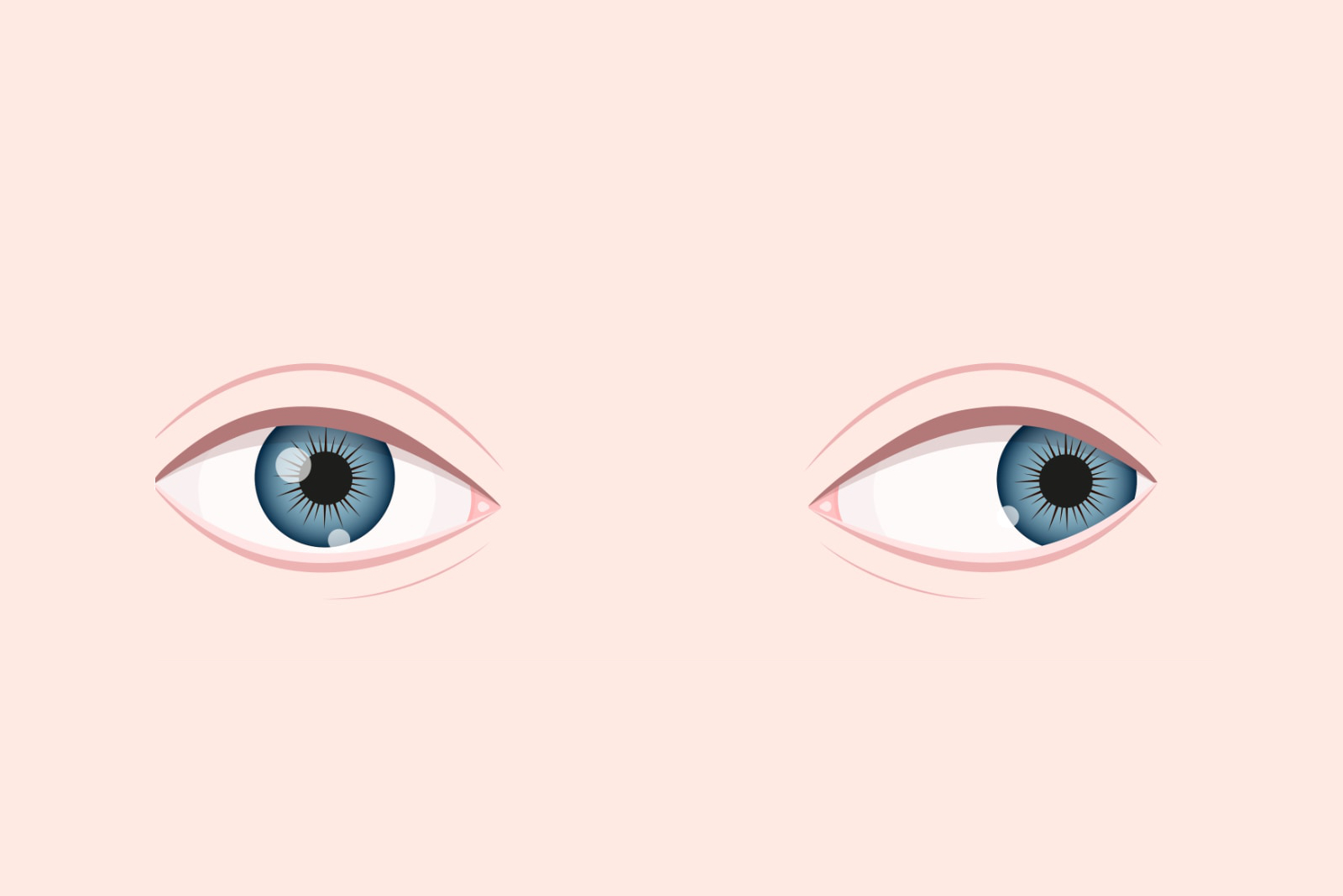 exotropia ochi