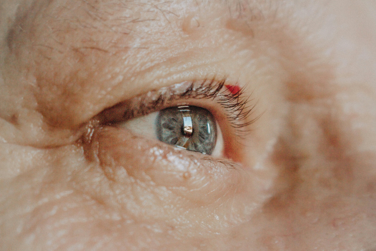 Cataracta